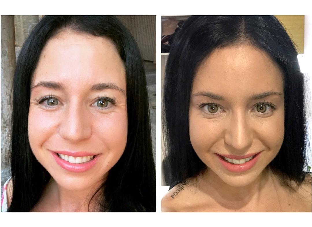 eliminació arrugues Botox